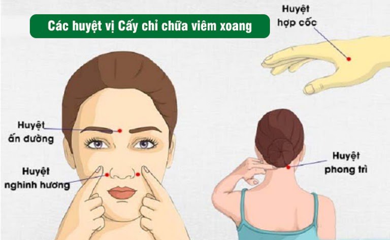 Bác sĩ có thể chữa viêm xoang bằng đông y với phương pháp cấy chỉ