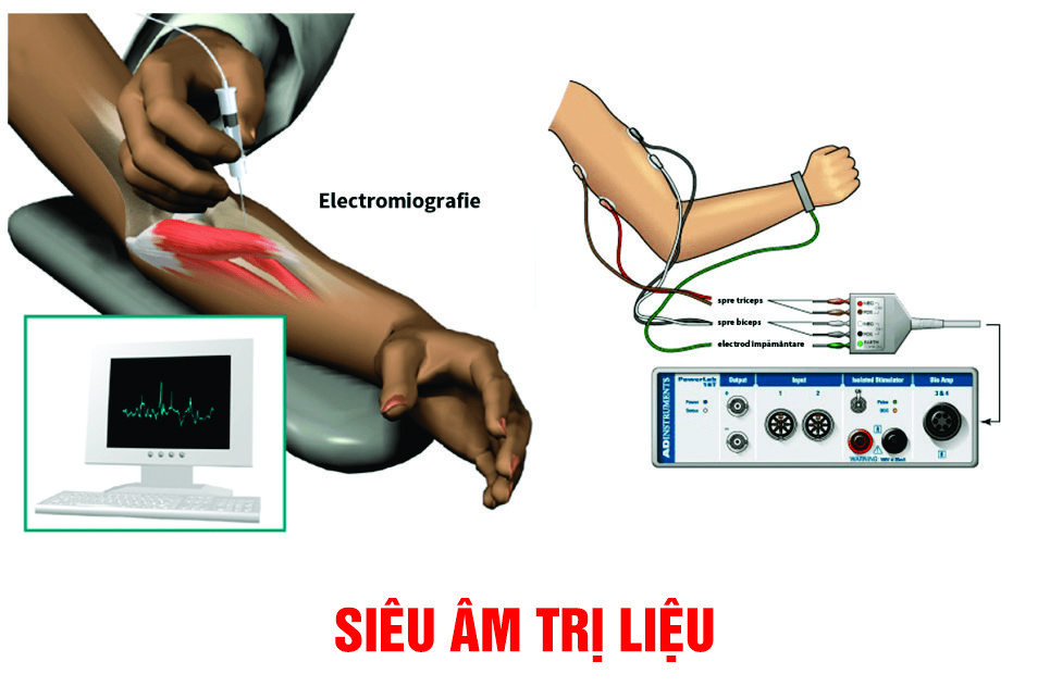 Siêu âm trị liệu được ứng dụng trong điều trị hội chứng ống cổ tay