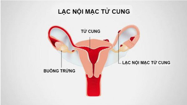 triệu chứng của lạc nội mạc tử cung