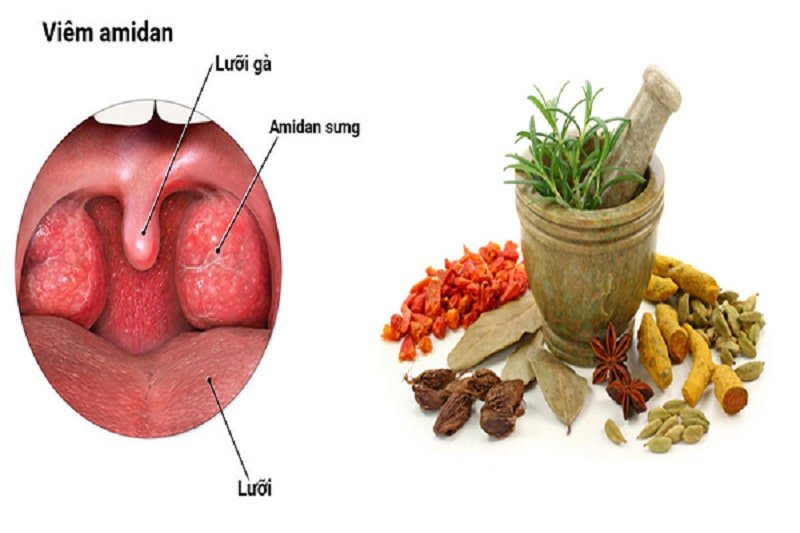 Dùng Đông y chữa viêm amidan cho trẻ