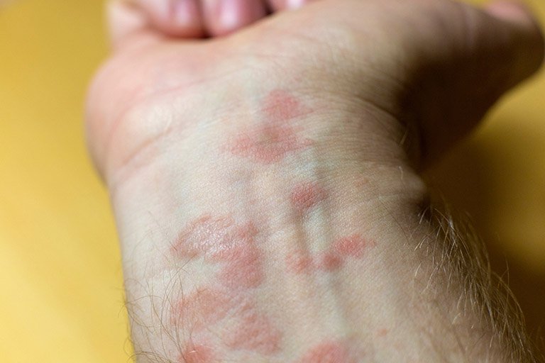 Có thể chữa Eczema bằng đông y?